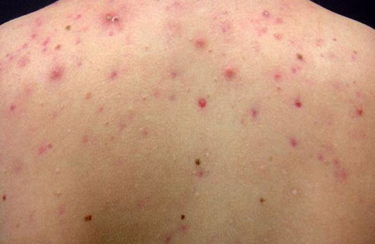 Nổi Mẩn Đỏ Ở Lưng Không Ngứa: Nguyên Nhân Và Cách Điều Trị 