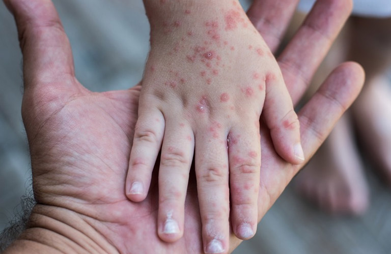 Nguyên Nhân, Triệu Chứng Và Cách Điều Trị Nổi Mẩn Đỏ Ở Tay