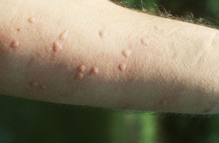 Nổi Mề Đay Nên Kiêng Gì? 10 Thực Phẩm Người Bệnh Cần Tránh