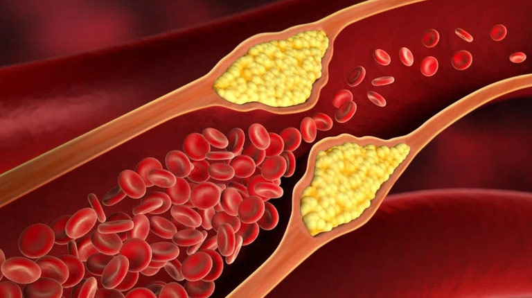 Mỡ máu chính là nguyên nhân gây ra 200.000 ca đột quỵ mỗi năm tại Việt Nam