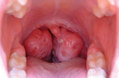 Áp xe amidan là tình trạng nhiễm trùng nghiêm trọng, hình thành khi mủ tích tụ quanh vùng amidan do vi khuẩn tấn công