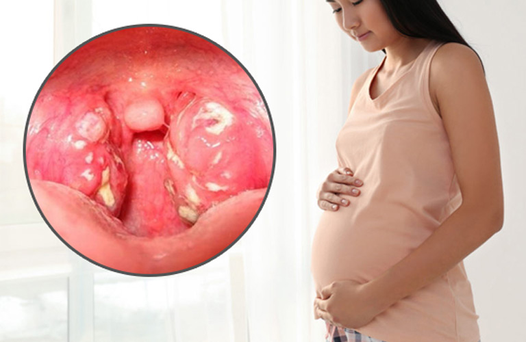 Viêm amidan là tình trạng viêm nhiễm hai khối mô nằm ở hai bên cổ họng của bà bầu