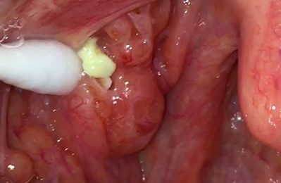 Bã đậu amidan là tình trạng các mảng trắng hoặc vàng đục tích tụ trong hốc amidan