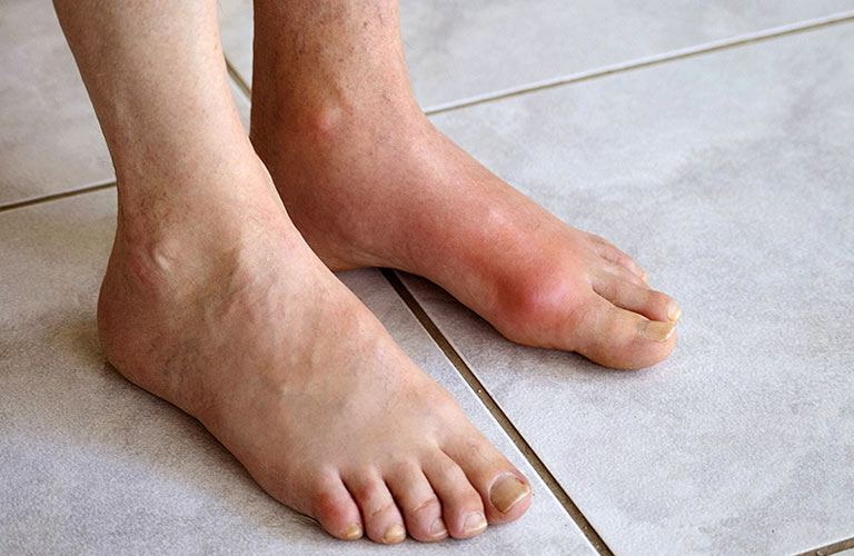 Tuấn tôi chưa từng gặp trường hợp bệnh gout lây từ người này sang người khác