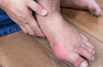 Bệnh gút là một loại viêm khớp gây đau đớn, hình thành do sự tích tụ của acid uric trong máu