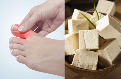 Trong trường hợp bệnh gút đang trong giai đoạn ổn định, đậu phụ có thể được ăn với lượng vừa phải