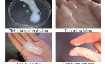 Cách nhận biết tinh trùng loãng hay đặc