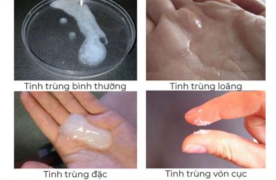 Cách nhận biết tinh trùng loãng hay đặc