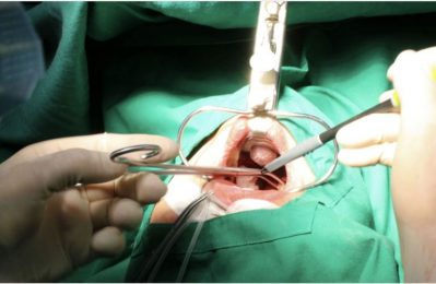 Cắt amidan bao lâu thì hồi phục?