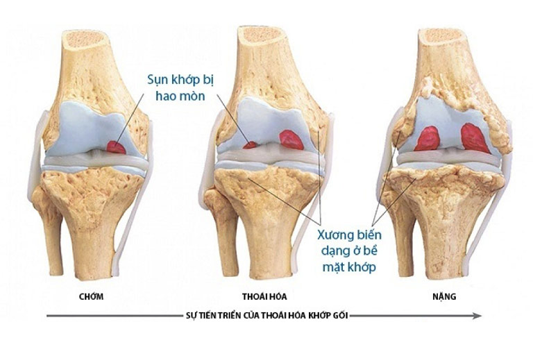 Khi khớp gối bị thoái hóa, lớp sụn khớp mòn dần, gây đau, sưng và cứng khớp