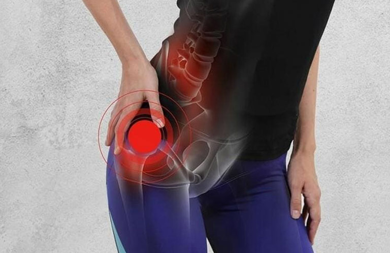 Cơn đau thường xuất hiện ở vùng háng, có thể lan xuống đùi hoặc lưng dưới