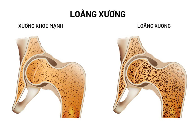Khi xương bị loãng, chúng trở nên yếu và dễ bị gãy, gây ra những cơn đau ở các khớp và xương