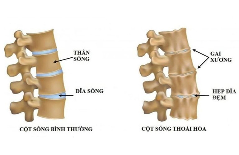 Các đốt sống cổ bị thoái hóa, gây chèn ép các dây thần kinh và mạch máu