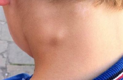 Đau vai gáy nổi hạch là hiện tượng xuất hiện cơn đau vùng cổ, vai gáy có nổi hạch