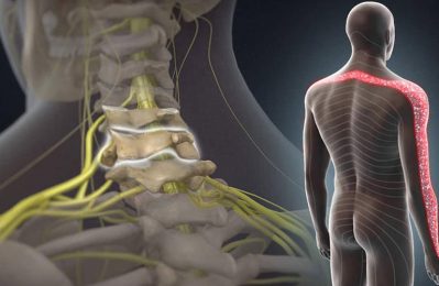 Mỏm gai xương ở các đốt sống phát triển quá mức và chèn ép lên các dây thần kinh trong cột sống