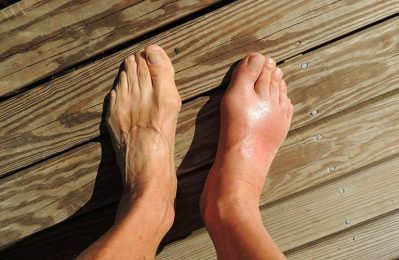 Gout cấp tính là một loại viêm khớp do sự tích tụ của các tinh thể urat trong khớp