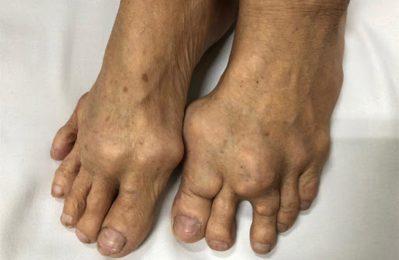 Gout mãn tính là tình trạng viêm khớp kéo dài do sự tích tụ của axit uric trong cơ thể