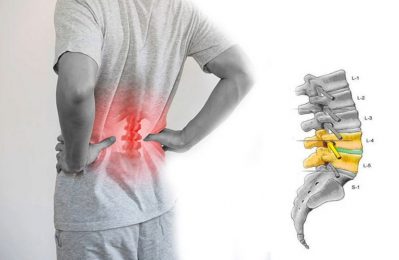 Đĩa đệm giữa hai đốt sống L4 và L5 trong cột sống thắt lưng bị thoái hóa, làm mất khả năng đàn hồi