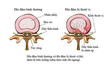 Nếu vết rách ở mức độ nhẹ, cơ thể vẫn có khả năng hồi phục