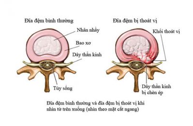 Nếu vết rách ở mức độ nhẹ, cơ thể vẫn có khả năng hồi phục