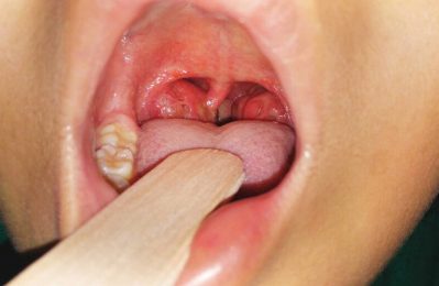 Sưng amidan là tình trạng viêm nhiễm ở amidan, cơ quan nằm ở hai bên cổ họng