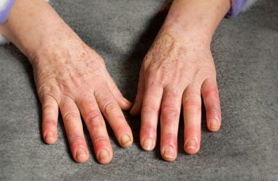 Sưng khớp ngón tay khiến khớp ngón tay bị đau, viêm và mất chức năng cử động