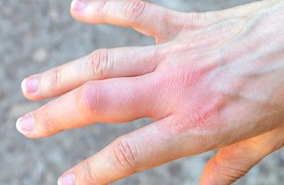 Sưng khớp tay là tình trạng viêm hoặc tổn thương tại các khớp của tay, thường gây đau