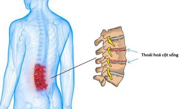 Thoái hóa cột sống là sự lão hóa tự nhiên của các đốt sống và các cấu trúc xung quanh