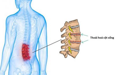 Thoái hóa cột sống là sự lão hóa tự nhiên của các đốt sống và các cấu trúc xung quanh