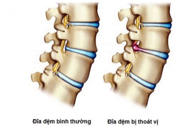 Có thể chữa được thoát vị đĩa đệm nhưng phụ thuộc vào mức độ bệnh và phương pháp điều trị