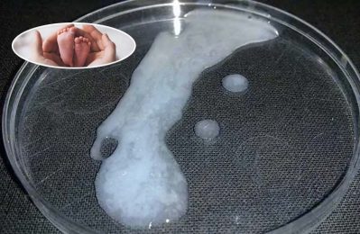 Tinh trùng vón cục có thể ảnh hưởng đến khả năng thụ thai