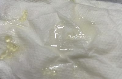 Khi tinh trùng vón cục quá nhiều, khả năng di chuyển và tiếp cận với trứng có thể bị hạn chế