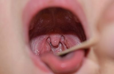 Trẻ bị viêm amidan mãn tính là tình trạng amidan bị viêm nhiễm kéo dài, thường xuyên tái phát