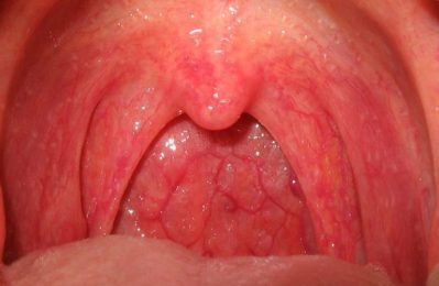 Viêm họng cấp là tình trạng viêm nhiễm xảy ra ở niêm mạc họng, phổ biến ở trẻ em