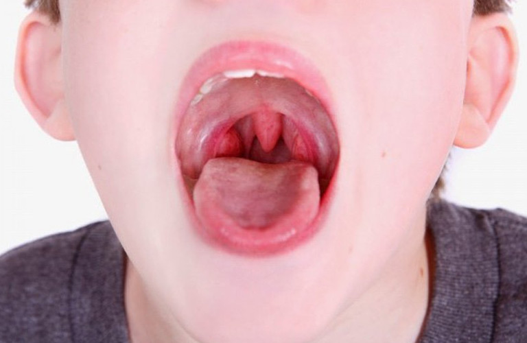 Viêm amidan cấp ở trẻ em thường xảy ra do các yếu tố tác động như vi khuẩn hoặc virus