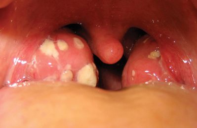 Viêm amidan có mủ ở người lớn là tình trạng viêm nhiễm tại amidan có sự xuất hiện của mủ trắng hoặc vàng trong họng