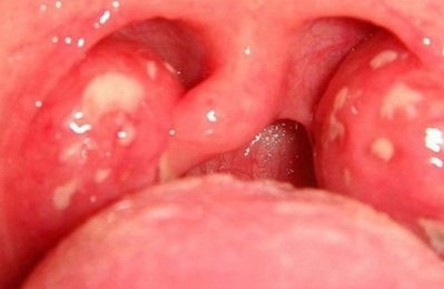 Viêm amidan hốc mủ là tình trạng viêm nhiễm nặng của amidan, khiến amidan sưng tấy và xuất hiện mủ