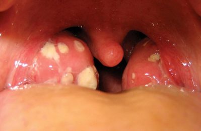 Viêm amidan mủ ở trẻ em là tình trạng viêm nhiễm nặng ở amidan, do vi khuẩn gây ra