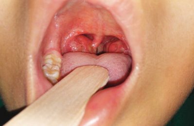 Viêm amidan ở trẻ em là tình trạng viêm nhiễm ở amidan, cơ quan lympho nằm ở phía sau họng