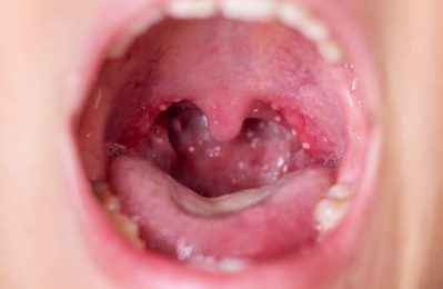 Viêm amidan quá phát là tình trạng amidan bị viêm nhiễm kéo dài và tái phát nhiều lần