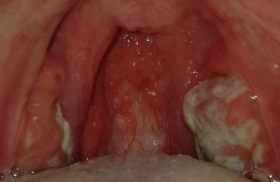 Viêm họng bạch hầu là một bệnh nhiễm trùng cấp tính do vi khuẩn Corynebacterium diphtheriae gây ra