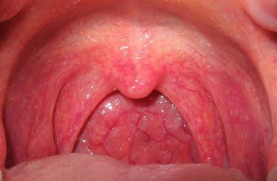 Viêm họng cấp thường khởi phát đột ngột, với các triệu chứng như đau rát họng, ho, sốt