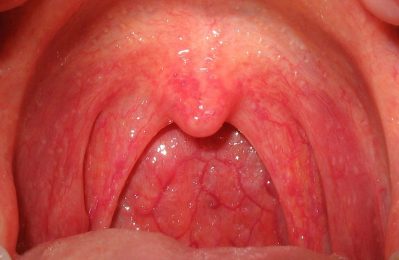 Viêm họng cấp J02 là một bệnh nhiễm trùng ở vùng họng, thường do vi khuẩn hoặc virus gây ra