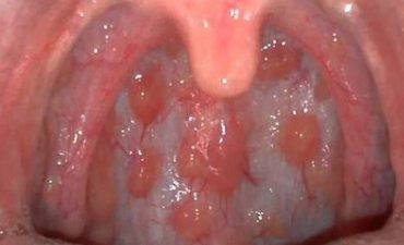 Viêm họng hạt là một tình trạng viêm nhiễm mãn tính tại vùng họng