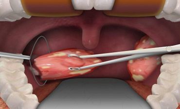 Viêm họng hạt có nên đốt không? Lương y Tuấn chia sẻ kinh nghiệm điều trị