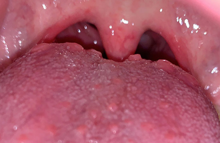 Viêm họng hạt ở lưỡi là tình trạng viêm nhiễm tại các hạt lympho ở khu vực phía sau lưỡi