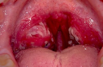 Viêm họng liên cầu khuẩn là một bệnh nhiễm trùng do vi khuẩn Streptococcus gây ra