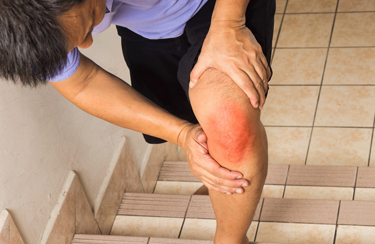 Tình trạng viêm khớp cấp tính có thể xảy ra, gây đau và sưng khớp, đặc biệt là ở gối và cổ tay
