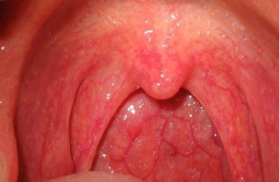 Viêm họng mãn tính không thể chữa khỏi hoàn toàn trong mọi trường hợp