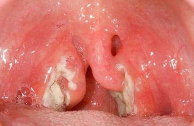 Viêm họng mủ là một loại nhiễm trùng ở họng do vi khuẩn gây ra